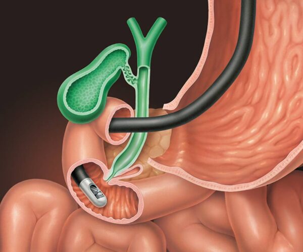 Bile Duct Stone or Obstruction