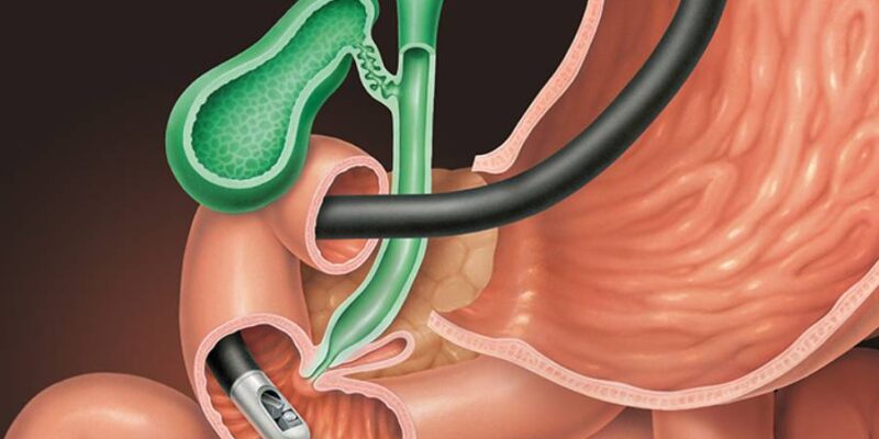 Bile Duct Stone or Obstruction Bile Duct Stone or Obstruction