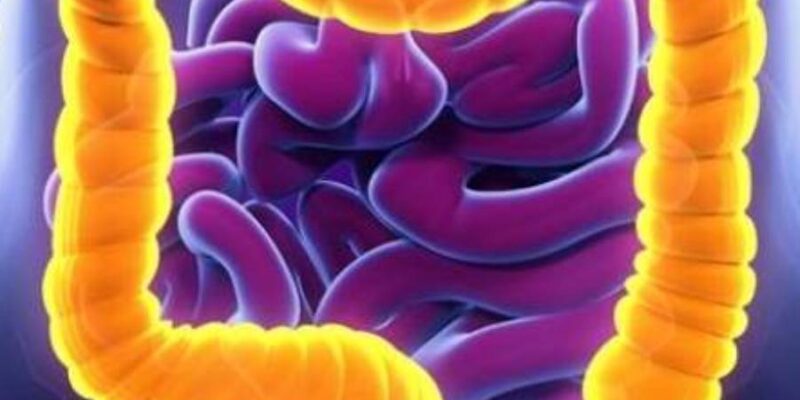 Colitis Colitis