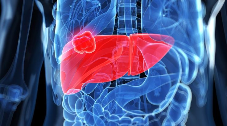 Livercancer 1