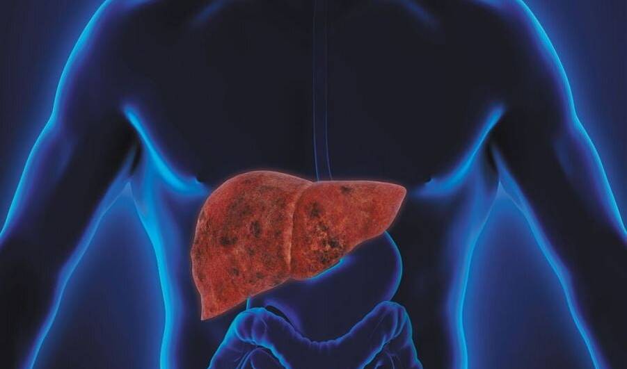 Liver Cirrhosis (1)