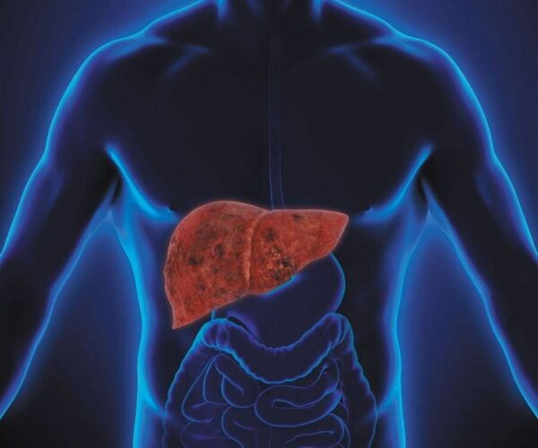 Liver Cirrhosis