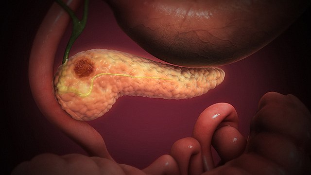 Pancreatitis 1